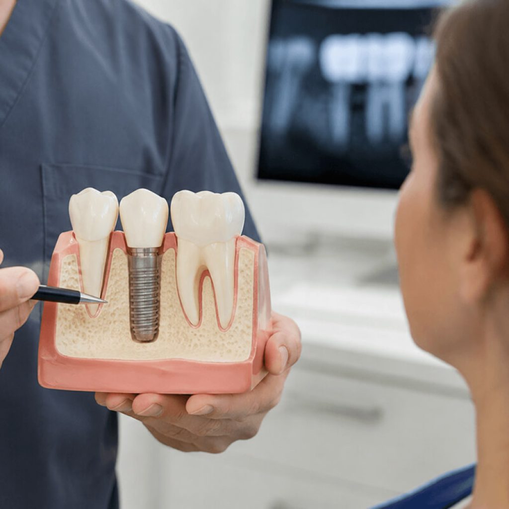 Dental Implants