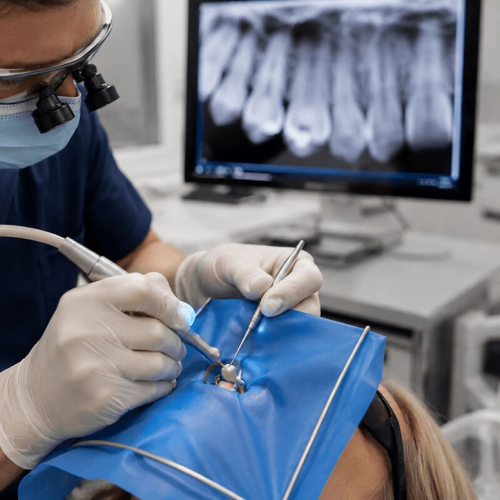 Root Canal Treatment